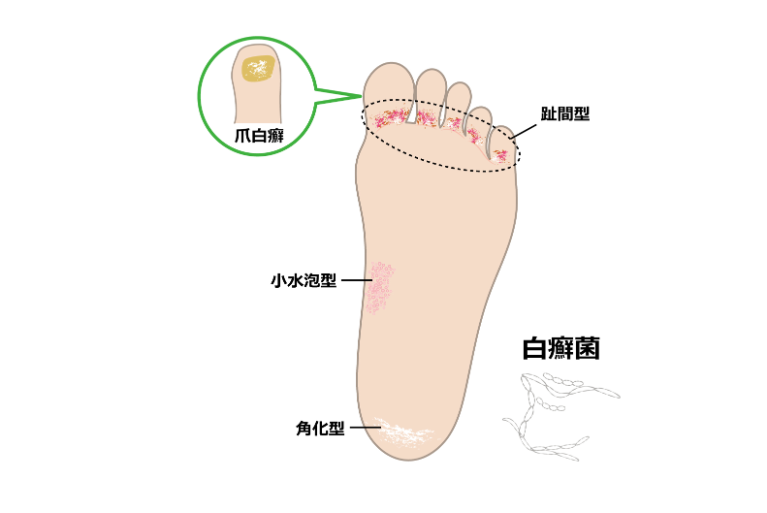 白癬（水虫）