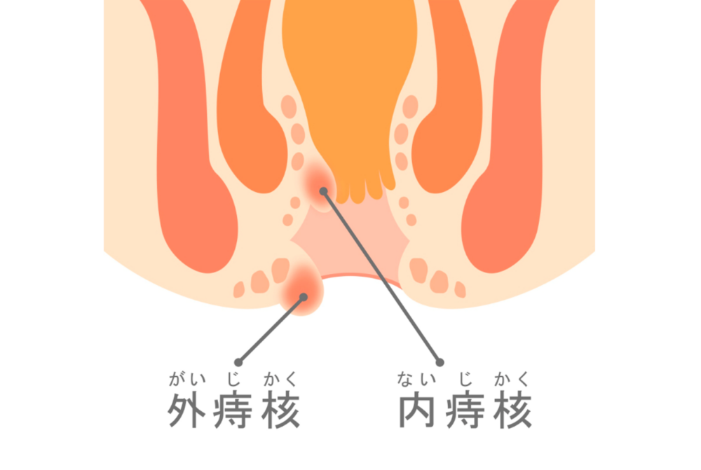 痔（内痔核、外痔核、裂肛、痔瘻など）